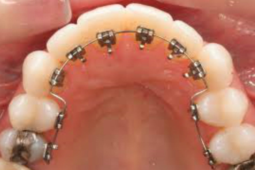 Profile OrthodonticsHow Well Do Lingual Braces Work? - Profile Orthodontics